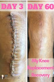 Pin On Mykneereplacementrecovery Com