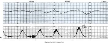 Image result for Late Deceleration