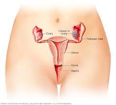 Ovarian cancer is when abnormal cells in the ovary begin to multiply out of control and form a tumor. Ovarian Cancer Symptoms And Causes Mayo Clinic