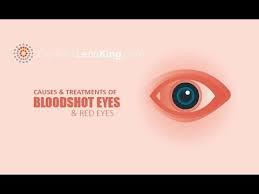 A cold compress can help relieve swelling around the eyes and reduce itching. Bloodshot Eyes Red Eyes Causes And Treatments Youtube