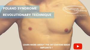 The disorder is primarily characterised by a deficiency in the development of the pectoral muscles in the chest. Anatomikmodeling Poland Syndrome En Youtube