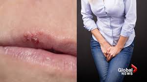 How the test is performed. Why Do I Keep Getting Cold Sores National Globalnews Ca