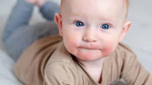 Eczema (atopic dermatitis) thrush (oral yeast infection) an allergic reaction (contact dermatitis) local irritation. Neurodermitis Creme Im Test Welche Basispflege Wir Bei Atopischem Ekzem Empfehlen Oko Test