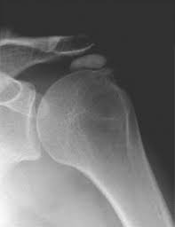 Image result for Rotator Cuff Calcification