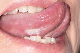 Image result for dental cancer