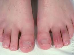 Image result for Chilblains