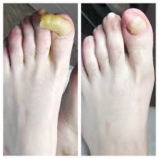 Image result for Onychogryphosis feet