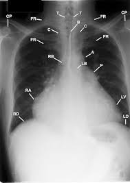Image result for XRay Changes in Rheumatic Conditions