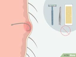 Many people who have thick or curly hair get a type of ingrown hair called pseudofolliculitis. How To Get Rid Of Ingrown Pubic Hair With Pictures Wikihow