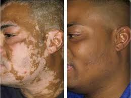 The Secret Home Vitiligo Cure 2019 By Abdel Lemsi Medium