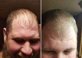 Actual cbd oil is a concentrated form extracted from cbd. Cbd Oil And Hemp Shampoo For Hair Growth Can They Stop Hair Loss