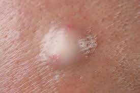 Image result for Skin Abscess