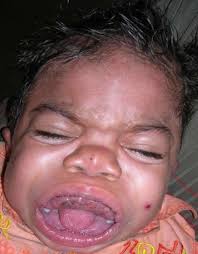 Hurler Syndrome Causes Symptoms Diagnosis Treatment Life Expectancy