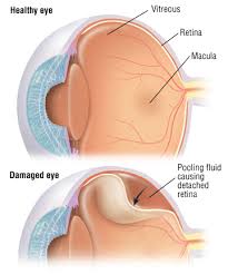 Detached Retina Harvard Health