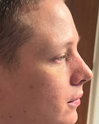 Resultado, SOLO 1 SEMANA después de su RINOPLASTIA. !!! INCREÍBLE !!!