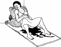 Emergency Care For Problems After Miscarriage Or Abortion Hesperian Health Guides