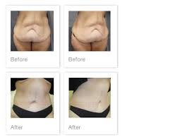 Search for pictures tummy tuck at sprask. Mr Oliver S Abdmonioplasty Before After Patient Results David Oliver Consultant Plastic Reconstructive And Aesthetic Surgeon Devon South West Of Uk