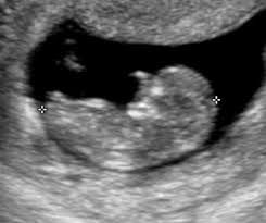 Conseils de kopines à 18 semaines de grossesse 20 sa. Echographie Obstetricale