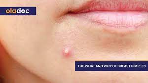 What are the symptoms, and how is it diagnosed and treated? The What And Why Of Breast Pimples Beauty And Skin Care Women S Health Oladoc Com