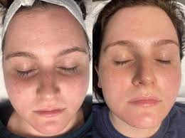 Getting Rid of Acne Scars