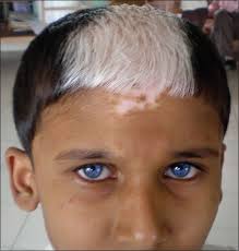 Some people also end up losing color inside their mouths. Vitiligo Hair Does Vitiligo Lead To Hair Loss