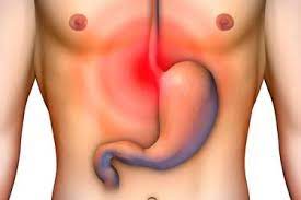 Sintomas De La Hernia De Hiato 5 Senales Para Identificarla