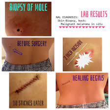 Pin On Melanoma Awareness