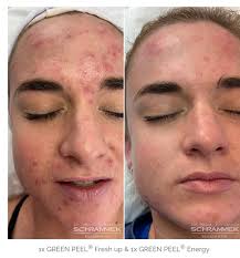 Green Peel von Dr. med. Christine Schrammek