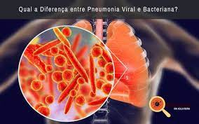 Bacterial pneumonia is a lung infection caused by bacteria. Qual A Diferenca Entre Pneumonia Viral E Bacteriana Dra Keilla Freitas