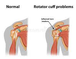 Screening the athlete's shoulder for impingement symptoms: Shoulder Impingement Stock Illustrations 26 Shoulder Impingement Stock Illustrations Vectors Clipart Dreamstime