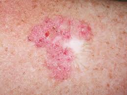 They contain powerful medicines that cause a painful irritation in the treated area. How To Use Fluorouracil And Imiquimod As Treatments For Non Melanoma Skin Cancer In A General Practice Setting Best Practice Advocacy Centre New Zealand