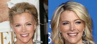 Résultat de recherche d'images pour "megyn kelly implants"