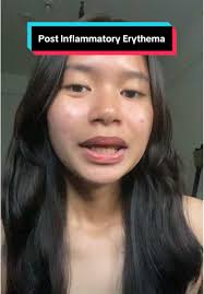 PIE? we only know how to get unREDdy! Dealing with these marks may take  longer than expected, but here's to trusting that it can get better 🥂  #getunREDdy #DrJart #sensitiveskin #sensitiveskincare ...