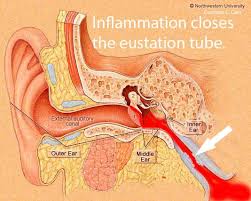 Most ear infections clear up within 3 days, although sometimes symptoms can last up to a week. The Eustation Tube Closes And Fills With Mucus Ear Infection Middle Ear Natural Cures