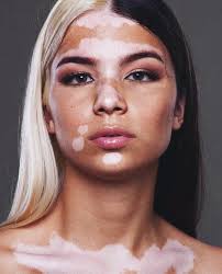 Pretty Girls With Vitiligo Google Search Hair Hair Fotos De Rosto Beleza De Mulher
