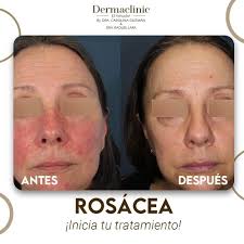 La rosácea es una afección común de la piel que causa rubor o  enrojecimiento y vasos sanguíneos visibles en la cara. Para iniciar tu  tratamiento puedes consultar a través de nuestro WhatsApp