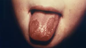 Blisters On The Tongue Pictures Causes And Treatments