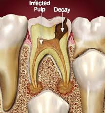 If it's a fairly easy procedure where the root remains intact, you can expect to be done in potentially under an hour. Baby Root Canals When And Why