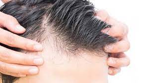 pin by vivi on s glow prp hair treatment hair transplant prp hair