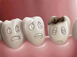Cavities in between teeth, also known as interproximal cavities, are caries areas that develop into holes. How To See A Cavity Like A Dentist Kingstowne Family Dentistry