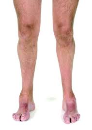 Maybe you would like to learn more about one of these? Charcot Marie Tooth Disease Demyelinating Type 1a Teeth Diseases Disease Medical Tech