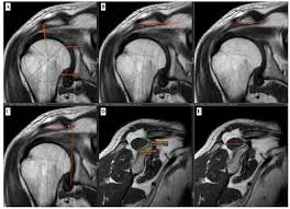 Image result for Shoulder MRI