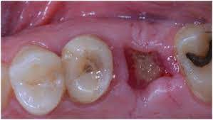 Tooth sockets immediately after the extraction process. Recovery After Wisdom Teeth Extraction Moira Wong Orthodontics