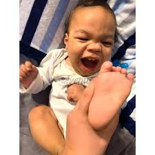 Asher's Clubfoot Journey