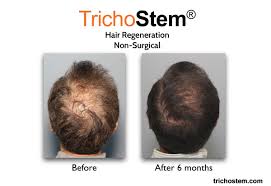 .but i had very thin hair as i grow up with dieting hair loss increased , now with optimal therapy topical minoxidil and oral vitamins result isnot satisfactory , acell and prp any recommendation ? Acell Prp Treatment Why They Aren T All The Same Trichostem