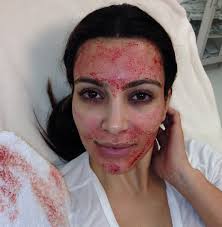 Vampire facials is the new trend dominating the beauty bracket