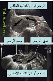 طبيب الوب انقلاب الرحم الخلفي
