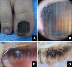Image result for Acral lentiginous melanoma nail