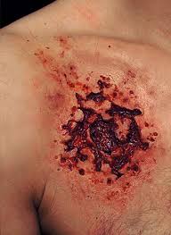 Buckshot is the shotgun load people fear most. 00 Buckshot Wound