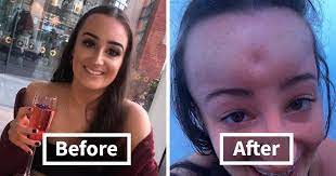 Girl Starts To Look Like An Alien Due To Swelling Head Does Nothing Until Her Eyes Almost Swell Shut Bored Panda